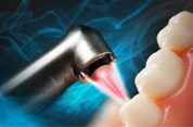 Laser Dentistry